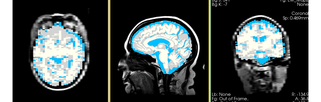 MRI-Human-Brain-HIPR-T1Flair map.png