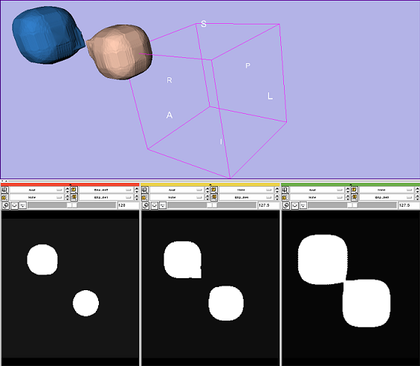 Slicer3:module:binarydilateoperations-documentation-3.2 - Slicer Wiki