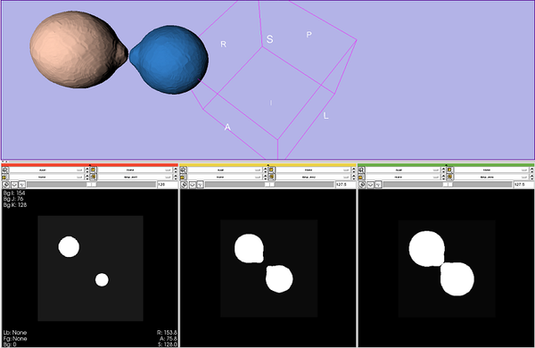 Slicer3:Module:BinaryDilateOperations-Documentation-3.2 - Slicer Wiki