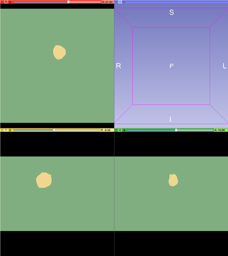 Documentation/4.4/Modules/Editor/WatershedFromMarkers - Slicer Wiki